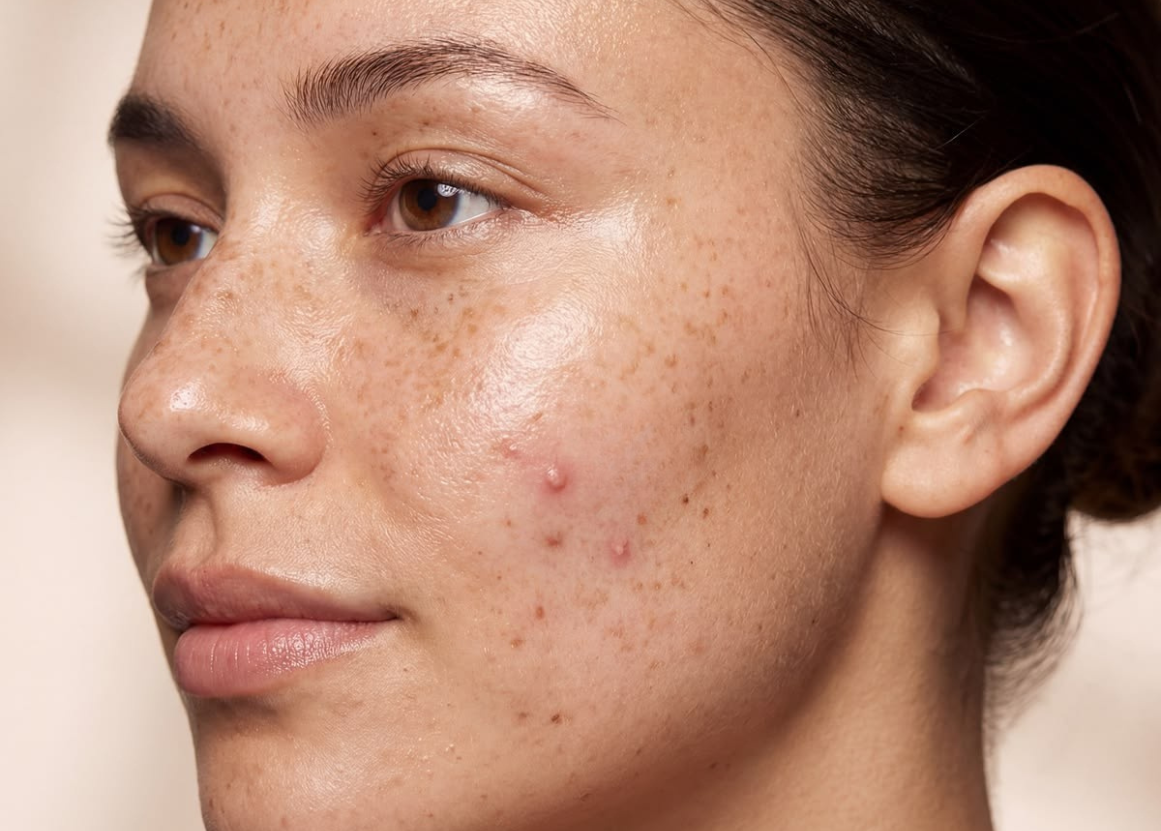 The Clinical Guide to Treating Acne: What Actually Works